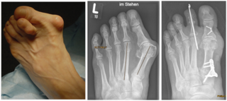 krallenzeh_Bild1_Klinik_Manhagen