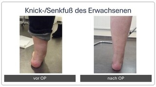 Knick_Senkfuss_vor_und_nach_Operation_2.png