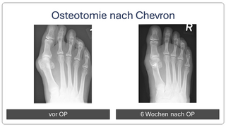 Hallux_valgus_vor_und_nach_op_2
