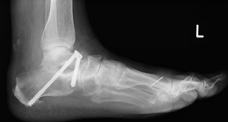 Knick-Senkfuss_des_Erwachsenen_Roentgen2