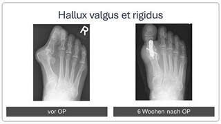 hallux_rigidus_vor_und_nach_OP3