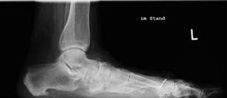 Knick-Senkfuss_des_Erwachsenen_Roentgen1