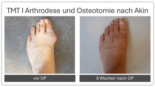 Hallux_valgus_vor_und_nach_op_7