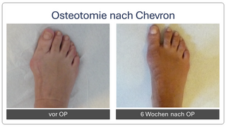 Hallux_valgus_vor_und_nach_op_1