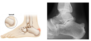 Haglund_Exostose_Roentgenbild1