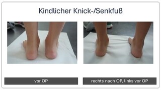 Kindlicher_Knick_Senkfuss_vor_und_nach_Operation_1.png