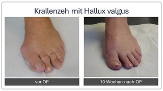 Krallenzeh_mit_Hallux_Valgus_vor_und_nach_OP_3