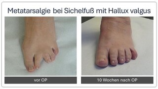 Metatarsalgie_Vor_und_nach_OP_3