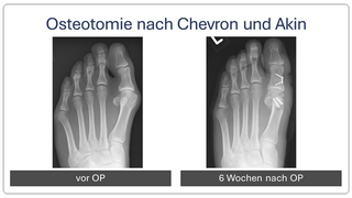 Hallux_valgus_vor_und_nach_op_4