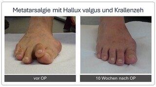 Metatarsalgie_Vor_und_nach_OP_1