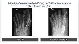 Metatarsalgie_Vor_und_nach_OP_4