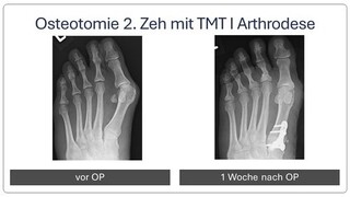 Krallenzeh_mit_Hallux_Valgus_vor_und_nach_OP_4