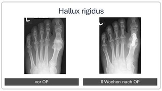hallux_rigidus_vor_und_nach_OP1