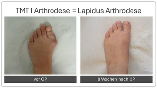 Hallux_valgus_vor_und_nach_op_5