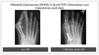 Metatarsalgie_Vor_und_nach_OP_2