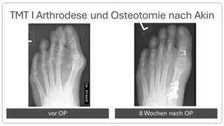 Hallux_valgus_vor_und_nach_op_8