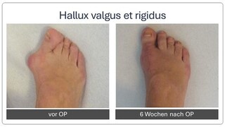 hallux_rigidus_vor_und_nach_OP2