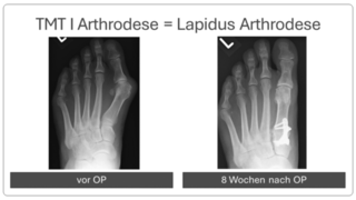 Hallux_valgus_vor_und_nach_op_6